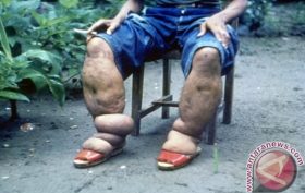 Penyakit Kaki Gajah Berbahaya Dan Menular, Warga Barsel Diminta Waspada