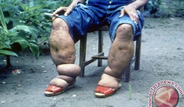 Penyakit Kaki Gajah Berbahaya Dan Menular, Warga Barsel Diminta Waspada